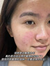 Newliann醫(yī)用重組三型人源化膠原蛋白乳液修復(fù)敷料凝膠人表皮生長(zhǎng)因子面霜 曬單實(shí)拍圖