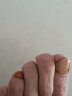 福美宜生灰指甲专用抑菌液去除缓解灰指甲厚指脱甲灰甲净专用修复液灰指甲 灰指甲专用液1盒 实拍图