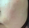 莘護疤痕修復凝膠成人醫用硅酮透明質(zhì)酸凝膠疤痕膏疤痕輔助改善預防醫用疤痕凝膠15g 曬單實(shí)拍圖