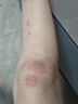 邦爾康醫用專(zhuān)用燒傷燙傷膏正品愈合特快速皮膚止痛熱油開(kāi)水外用銀鋅霜效好特快10g 贈紗布涂抹棒 曬單實(shí)拍圖
