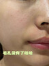 醫(yī)用精華液械字號(hào)收縮毛孔粗大修復(fù)細(xì)致去黑頭粉刺閉口男士女士祛痘印黑色素沉淀控油淡化痘印痘坑透明質(zhì)酸鈉 曬單實(shí)拍圖