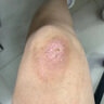 金芭克醫(yī)用祛疤膏醫(yī)用疤痕凝膠巴克除硅酮去疤膏美國(guó)進(jìn)口原料兒童面部雙眼皮手術(shù)增生剖腹產(chǎn)燒傷燙傷疤痕修護(hù) 金芭克祛疤膏一盒（15g） 曬單實(shí)拍圖