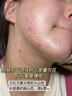 片仔癀祛痘控油青春痘去痘水乳洗面奶細(xì)致毛孔青春期青少年學(xué)生閉口粉刺 祛痘乳+潔面【立省15】 曬單實(shí)拍圖