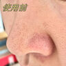 華美科 HURMEVKOR黑頭清理神器鼻貼去黑頭修復(fù)毛孔收縮毛孔粉刺深層清潔黑頭導(dǎo)出液 毛孔凈澈去黑頭護(hù)理套盒*2 曬單實(shí)拍圖