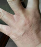 洗碗手指縫潰爛癢長(zhǎng)期碰水專(zhuān)用膏長(zhǎng)期洗碗手指縫潰爛癢爛手丫真菌感染手指中間腐爛開(kāi)裂瘙癢脫皮專(zhuān)用膏N3 兩盒裝 【第二盒半價(jià) 送棉簽】洗碗手指縫爛癢 曬單實(shí)拍圖
