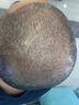 雍禾植發(fā) 剃發(fā)植發(fā)不限單位 大面積頭頂加密種植頭頂稀疏發(fā)縫大高額頭 剃發(fā)植發(fā)2000單位以上（含醫師費） 全國 曬單實(shí)拍圖