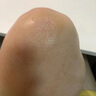 金芭克醫(yī)用祛疤膏醫(yī)用疤痕凝膠巴克除硅酮去疤膏美國(guó)進(jìn)口原料兒童面部雙眼皮手術(shù)增生剖腹產(chǎn)燒傷燙傷疤痕修護(hù) 金芭克祛疤膏一盒（15g） 曬單實(shí)拍圖
