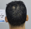 雍禾植發(fā)[主任團(tuán)隊(duì)] 適用發(fā)際線種植、頭頂加密、發(fā)縫種植、藝術(shù)植發(fā)等 剃發(fā)植發(fā)2000單位及以內(nèi)（一口價(jià)） 曬單實(shí)拍圖