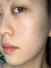 藤石制藥水痘疤痕修復凝膠兒童臉部凹陷成人祛水痘痘印痘坑可搭專(zhuān)用膏淡化疤痕疙瘩藥黑色素沉淀去除非藥ZE 2盒周期裝【少量面部水痘痘印疤痕】第二盒半價(jià) 曬單實(shí)拍圖