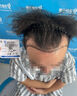 雍禾植發(fā)[主任團隊] 適用發(fā)際線(xiàn)種植、頭頂加密、發(fā)縫種植、藝術(shù)植發(fā)等 剃發(fā)植發(fā)2000單位以上（一口價(jià)） 曬單實(shí)拍圖