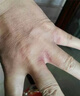 洗碗手指縫潰爛癢長(zhǎng)期碰水專(zhuān)用膏長(zhǎng)期洗碗手指縫潰爛癢爛手丫真菌感染手指中間腐爛開(kāi)裂瘙癢脫皮專(zhuān)用膏N3 兩盒裝 【第二盒半價(jià) 送棉簽】洗碗手指縫爛癢 曬單實(shí)拍圖