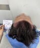 雍禾植發(fā)[主任團隊] 適用發(fā)際線(xiàn)種植、頭頂加密、發(fā)縫種植、藝術(shù)植發(fā)等 剃發(fā)植發(fā)2000單位以上（一口價(jià)） 曬單實(shí)拍圖