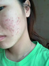 安伊妮青少年凈痘精華保濕乳液男女夏季淡化祛痘膏修護(hù)屏障控油精華乳霜 曬單實(shí)拍圖