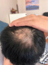 秘造防脫育發(fā)液激活毛囊增發(fā)密發(fā)長(cháng)發(fā)劑脫發(fā)嚴重專(zhuān)用營(yíng)養液頭發(fā)生長(cháng)液 【十瓶】適合多年脫發(fā)禿頂人群 曬單實(shí)拍圖