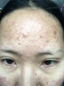DL胖東來(lái) 痘印痘疤豆豆青春痘痘坑修復草本植萃祛痘膏女男 涂完就好 曬單實(shí)拍圖