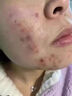清熱解毒去痤瘡?fù)枘樕先ザ欢坏乃庰畀復(fù)桁疃荒摪挴徬掳图t腫硬去痘痘和痘印修復(fù)淡化痘印去粉刺 清熱暗瘡?fù)?發(fā)一盒紅霉i素軟膏 曬單實拍圖