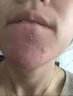 Revive Source凍干粉祛痘上火痘去粉刺閉口去痘痘寡肽多肽精華男女護(hù)膚品 祛痘粉刺閉口凍干粉【1盒12瓶】 曬單實(shí)拍圖