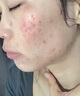阿達帕林凝膠醫(yī)用袪痘消炎痤瘡專用青少年 痘痘藥膏治療座瘡臉上長痘痘的藥 痤瘡膏 膿皰瘡小顆粒皮膚用藥 3盒【臉上長痘】 曬單實拍圖