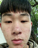 YYTISS祛痘藥膏淡化痘印消除坑炎痤瘡專(zhuān)用青少年去痘痘和痘印青春痘學(xué)生 曬單實(shí)拍圖