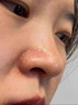 尤維佳維A酸乳膏醫用去黑頭閉口收縮毛孔 鼻子鼻頭粉刺清理 皮膚用藥祛痘消炎痤瘡草莓鼻男女士專(zhuān)用藥膏 1+1維生素b6軟膏 【醫用去黑頭】 曬單實(shí)拍圖