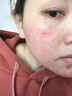 凱蕾娜醫用冷敷貼微整術(shù)后舒緩修復去腫痘痘肌花敏曬后過(guò)敏瘙癢肌膚女 凱蕾娜醫用冷敷敷料 一盒5片 曬單實(shí)拍圖