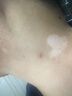 邦臣（BANGCHEN）308白癜風(fēng)治療儀光療儀醫院紫外線(xiàn)燈同款銀屑病白斑窄譜nbuvb激光 【強度60/面積10】UV308E3院線(xiàn)同款 曬單實(shí)拍圖