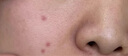 ICHTHYOL頤可修德國(guó)小藍(lán)管*3支醫(yī)美術(shù)后修復(fù)傷口快速愈合藥生長(zhǎng)因子凝膠疤痕修復(fù)愈合傷口京東自營(yíng)醫(yī)用傷口護(hù)理 曬單實(shí)拍圖