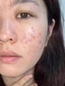 妍瑟水楊酸細致毛孔酸和壬二酸凝膠祛痘膏去痘痘和痘印去黑頭收縮毛孔 6支裝【壬二酸+水楊酸】3套 曬單實(shí)拍圖