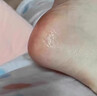 角化型腳氣頑固性腳后跟真菌感染干裂脫皮專(zhuān)用藥腳起硬皮足跟開(kāi)裂脫皮去真菌皮膚干裂腳趾縫潰爛爛腳丫華佗膏 1乳膏+1噴霧【搭配用 一抹一噴 雙效治】 曬單實(shí)拍圖