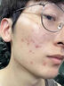 SKISGEM祛痘面膜1盒*10片水楊酸淡印褪印控油毛孔收縮德國進(jìn)口生日禮物 曬單實(shí)拍圖