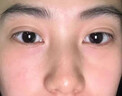 協(xié)南藥業(yè)去痣點痣膏祛痣點痣點疣藥水點痣醫(yī)用專用官方正品黑痣臉部不留疤 曬單實拍圖