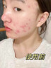 井次制藥祛痘膏去痘痘青春痘淡化痘印修復痘疤初高中男女學(xué)生閉口粉刺痤瘡 曬單實(shí)拍圖