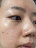 醫用精華液械字號收縮毛孔粗大修復細致去黑頭粉刺閉口男士女士祛痘印黑色素沉淀控油淡化痘印痘坑透明質(zhì)酸鈉 曬單實(shí)拍圖