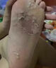 腳氣噴劑腳氣藥止癢脫皮爛腳丫真菌感染腳趾縫潰爛癢開裂水泡腳氣止癢殺菌治腳癬用藥鹽酸特比萘芬噴霧劑 1盒【噴一噴 殺菌止癢】 曬單實(shí)拍圖