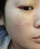 Newliann醫用重組三型人源化膠原蛋白外用人表皮生長(cháng)因子凝膠皮膚疤痕修復 曬單實(shí)拍圖