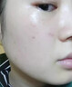 Newliann醫用重組三型人源化膠原蛋白外用人表皮生長(cháng)因子凝膠皮膚疤痕修復 曬單實(shí)拍圖