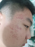 膚草集祛痘膏痘坑青春痘初高中學(xué)生痘痕修復(fù)改善粉刺痘疤蘆薈膠抗痘 曬單實(shí)拍圖