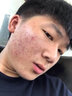同仁堂祛痘膏祛痘印修復淡化去痘痘和痘印痘坑青春痘粉刺閉口男女精華液 一盒裝【體驗裝】 曬單實(shí)拍圖