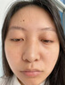 植詩霖百年草本皮膚保健膏祛痘痘去痘印閉口粉刺青春痘男女通用 柏枝霖祛痘膏15g 曬單實拍圖