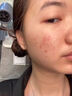 阿達(dá)帕林凝膠醫(yī)用祛痘消炎痤瘡專用藥膏去痘痘和痘印閉合性粉刺藥膏臉上長痘痘治療重度青春痘硬疙瘩皮膚用藥 1盒裝【粉刺膿包痘印】 曬單實拍圖