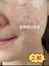 上宮莊祛痘膏頑痘凈加強(qiáng)型男女閉口粉刺青春痘痘痘印韓秀宮上官莊 25g 【急救突發(fā)痘】 曬單實(shí)拍圖