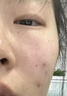 清熱拔解毒膏火癤子膿包疙瘩皮脂腺囊腫特新效期藥火癤子消炎藥專用藥身上屁股腿胳膊硬塊消腫止痛龍珠軟膏 1盒裝【火癤子 】國藥準字 曬單實拍圖
