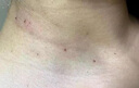 秋雅奈緒去除疣體藥膏疣清寧扁平疣絲狀疣瘊子專用脫落膏祛疣神器點(diǎn)痣藥水 祛疣軟膏買二送一【優(yōu)膚平進(jìn)口 去除面部脖子小肉粒尤猴子醫(yī)用軟 曬單實(shí)拍圖