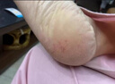 腳裂膏腳后跟干裂開裂真菌感染腳后跟干裂膏皸裂膏手足凍瘡防裂膏腳裂手裂腳后跟干裂皮裂膏冬天防裂尿素乳膏 1盒【手腳干裂腳后跟干裂開裂防裂膏】 曬單實(shí)拍圖