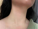 優(yōu)立特脖子毛囊炎噴劑噴霧馬拉色菌真菌感染治療頭部手臂上長(cháng)痘痘疙瘩NH 第二盒半價(jià)【2盒療程裝】少量毛囊痘痘 曬單實(shí)拍圖