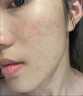 素秀臣氏小綠瓶祛痘精華液水楊酸去痘痘和淡化痘印坑修收縮黑頭粉刺復毛孔 2瓶裝 曬單實(shí)拍圖