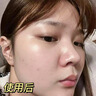 儒意愈創(chuàng)木祛痘面膜修復(fù)去痘痘和痘印控油毛孔收縮官方旗艦店正品女 【輕度痘痘適用】10片 曬單實(shí)拍圖