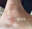 HIRUDOID泰國進(jìn)口疤痕修復(fù)膏剖腹產(chǎn)燒燙傷疤痕凝膠膏祛痘印術(shù)后皮膚修復(fù) hirudoid(舊疤 深疤痕）藍(lán)色40g 曬單實(shí)拍圖