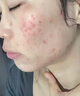 阿達帕林凝膠醫用祛痘消炎痤瘡專(zhuān)用藥 治療粉刺膿包青少年臉上長(cháng)硬疙瘩去痘痘的藥膏痘印想淡化消除皮膚用藥 1盒裝【內分泌失調 臉上長(cháng)痘】組合效果佳 曬單實(shí)拍圖