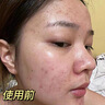 儒意愈創(chuàng)木祛痘面膜修復(fù)去痘痘和痘印控油毛孔收縮官方旗艦店正品女 【輕度痘痘適用】10片 曬單實(shí)拍圖